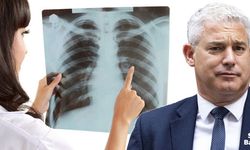 NHS, bir milyon kişiye akciğer kanser taraması yapacak