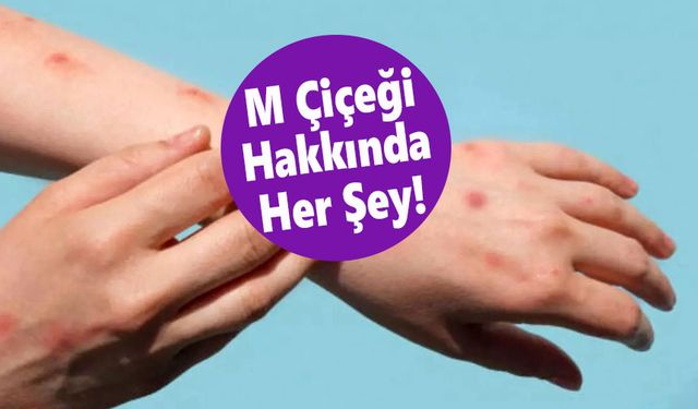 Maymun Çiçeği virüsü küresel mercek altında